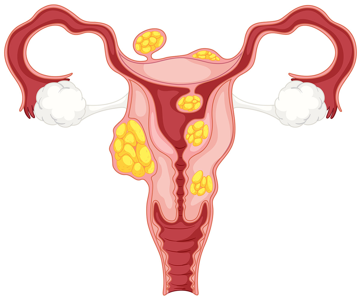 inomyomata_i_leiomyomata_tis_mitras-_mameletzi_sara.jpg inomyomata_i_leiomyomata_tis_mitras-_mameletzi_sara.jpg