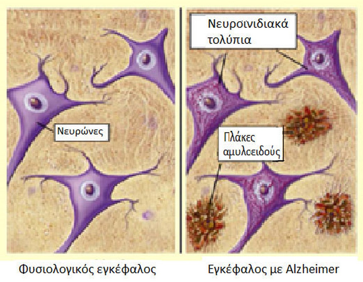 altzheimer-apth.jpg altzheimer-apth.jpg