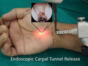endoscopic-carpal-tunnel-release-300x225.jpg endoscopic-carpal-tunnel-release-300x225.jpg