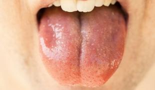glossa-stoma