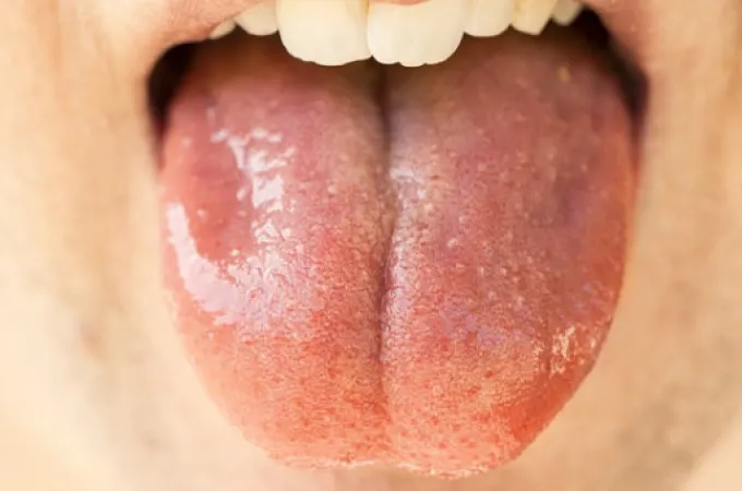 glossa-stoma
